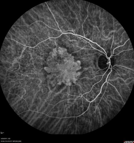 Asymptomatic wet AMD - Subfoveal CNM both eyes
82 year old woman - 20/25 OU. Images show occult subfoveal CNVM both eyes best seen on late ICG.  The left eye also has probable polypoidal choroidal vasculopathy.  No treatment was recommended on the first visit - follow-up at 1 month.
