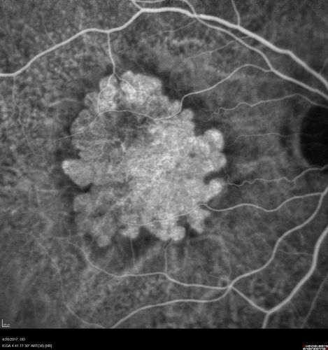 Asymptomatic wet AMD - Subfoveal CNM both eyes
82 year old woman - 20/25 OU. Images show occult subfoveal CNVM both eyes best seen on late ICG.  The left eye also has probable polypoidal choroidal vasculopathy.  No treatment was recommended on the first visit - follow-up at 1 month.

