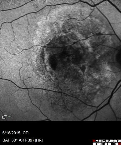 New wet AMD OS with subretinal hemorrhage and recent vision loss, Scar OD
