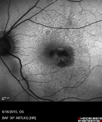 New wet AMD OS with subretinal hemorrhage and recent vision loss, Scar OD
