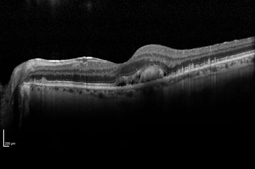 New wet AMD OS with subretinal hemorrhage and recent vision loss, Scar OD
