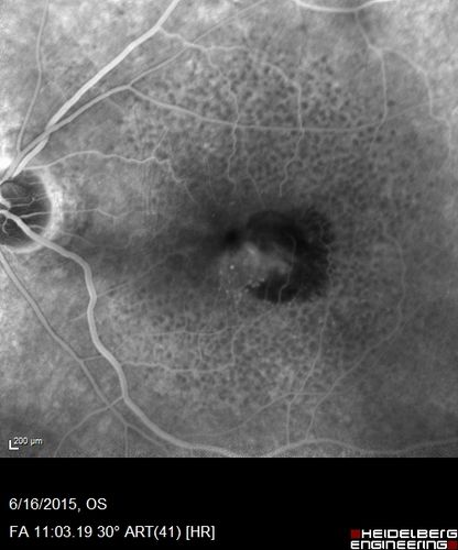 New wet AMD OS with subretinal hemorrhage and recent vision loss, Scar OD
