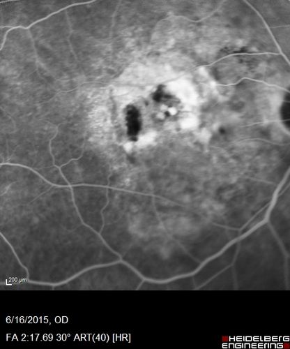 New wet AMD OS with subretinal hemorrhage and recent vision loss, Scar OD
