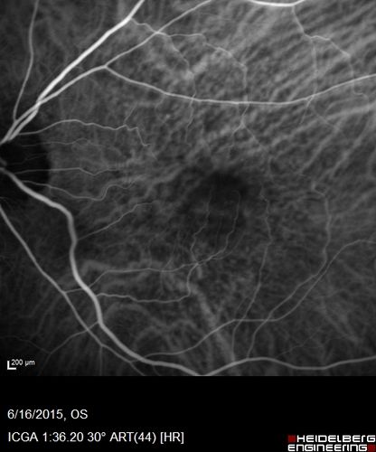 New wet AMD OS with subretinal hemorrhage and recent vision loss, Scar OD
