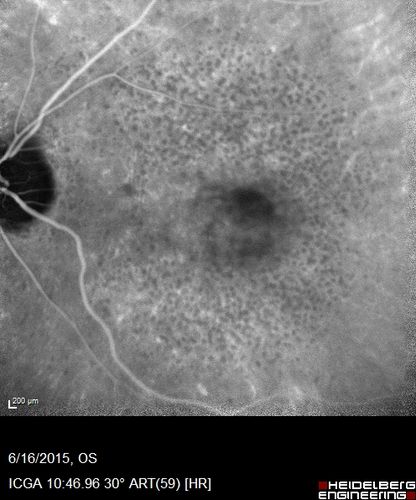 New wet AMD OS with subretinal hemorrhage and recent vision loss, Scar OD
