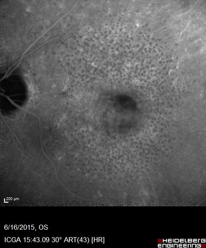 New wet AMD OS with subretinal hemorrhage and recent vision loss, Scar OD
