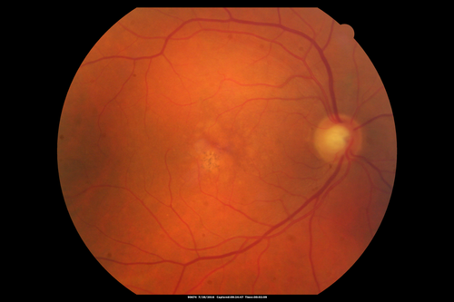 Macular Telangiectasia and dry AMD - Simulating wet AMD
This patient was told different things by different retina specialists.  Her case is complex because she has OCT findings of Macular Telangiectasis and dry AMD.  This makes it look like she has wet AMD.  Her vision is stable.
