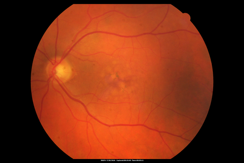 Macular Telangiectasia and dry AMD - Simulating wet AMD
This patient was told different things by different retina specialists.  Her case is complex because she has OCT findings of Macular Telangiectasis and dry AMD.  This makes it look like she has wet AMD.  Her vision is stable.
