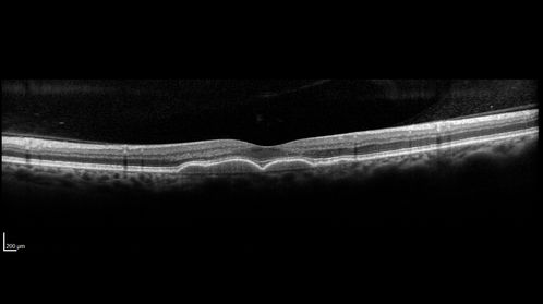 Macular Telangiectasia and dry AMD - Simulating wet AMD
This patient was told different things by different retina specialists.  Her case is complex because she has OCT findings of Macular Telangiectasis and dry AMD.  This makes it look like she has wet AMD.  Her vision is stable.
