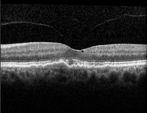 Macular Telangiectasia and dry AMD - Simulating wet AMD
This patient was told different things by different retina specialists.  Her case is complex because she has OCT findings of Macular Telangiectasis and dry AMD.  This makes it look like she has wet AMD.  Her vision is stable.
