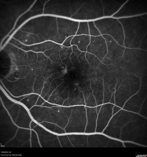 Macular Telangiectasia and dry AMD - Simulating wet AMD
This patient was told different things by different retina specialists.  Her case is complex because she has OCT findings of Macular Telangiectasis and dry AMD.  This makes it look like she has wet AMD.  Her vision is stable.
