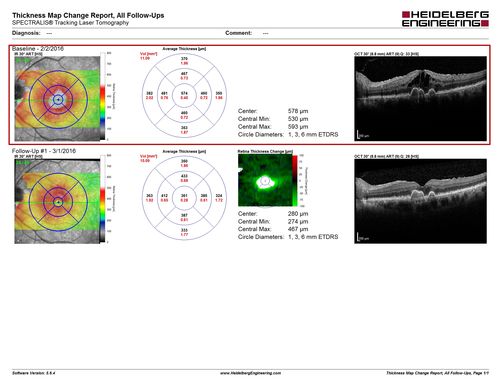 Macular Edema and dry AMD - excellent example of why FA and ICG are necessary in management of wet AMD
This 72 year old woman has an OCT that looks like wet AMD.  Only her FA and ICG show that she has inflammatory macular edema.  She had no clinical signs or symptoms of uveitis.  Nevertheless, the macular edema responded to subtenon's kenalog.

