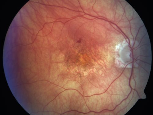 Vision Loss, Blood, and Cartwheel CNVM OD with no fluid on OCT Scan
86-year-old man has had changing vision.  He says his vision has been gradually declining since I saw him in June.  You saw a hemorrhage in the eye and suggested he comes in here for an evaluation.  He is on Combigan and Travatan in the right eye for his glaucoma.

VISUAL ACUITY:  Vision OD is 6/200 OS is 8/200 The  macula in the right eye is wet even though interestingly the OCT does not show subretinal fluid.
