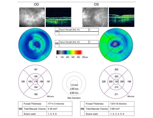 Vision Loss, Blood, and Cartwheel CNVM OD with no fluid on OCT Scan
86-year-old man has had changing vision.  He says his vision has been gradually declining since I saw him in June.  You saw a hemorrhage in the eye and suggested he comes in here for an evaluation.  He is on Combigan and Travatan in the right eye for his glaucoma.

VISUAL ACUITY:  Vision OD is 6/200 OS is 8/200 The  macula in the right eye is wet even though interestingly the OCT does not show subretinal fluid.
