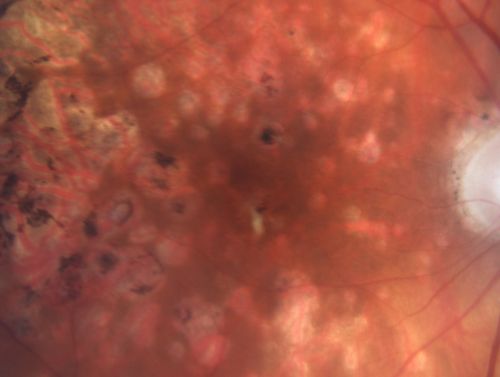 Macular Atrophy - Macular Degeneration and Previous Diabetic Macular Laser 72 Year Old Man
72-year-old man has age-related macular degeneration who had macular and peripheral laser done 30 years ago for diabetic retinopathy.  He has developed worsening macular atrophy in both eyes
