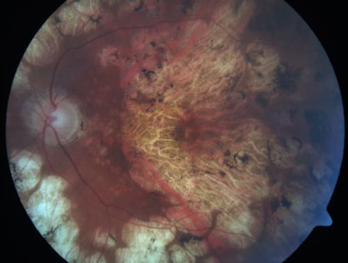 Macular Atrophy - Macular Degeneration and Previous Diabetic Macular Laser 72 Year Old Man
72-year-old man has age-related macular degeneration who had macular and peripheral laser done 30 years ago for diabetic retinopathy.  He has developed worsening macular atrophy in both eyes
