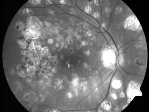 Macular and Peripheral Retinal Scarring from Diabetic Laser Done 25 years previously
72-year-old man had macular and peripheral laser done in the past(1980's)(25 years ago).  His vision, although limited, seems about stable to him.  He is diabetic for 30 years. OD is 20/160, OS  is 20/160.
