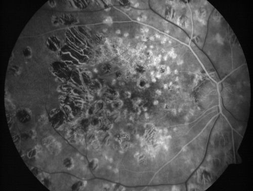 Macular and Peripheral Retinal Scarring from Diabetic Laser Done 25 years previously
72-year-old man had macular and peripheral laser done in the past(1980's)(25 years ago).  His vision, although limited, seems about stable to him.  He is diabetic for 30 years. OD is 20/160, OS  is 20/160.
