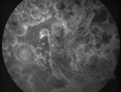 Macular and Peripheral Retinal Scarring from Diabetic Laser Done 25 years previously
72-year-old man had macular and peripheral laser done in the past(1980's)(25 years ago).  His vision, although limited, seems about stable to him.  He is diabetic for 30 years. OD is 20/160, OS  is 20/160.
