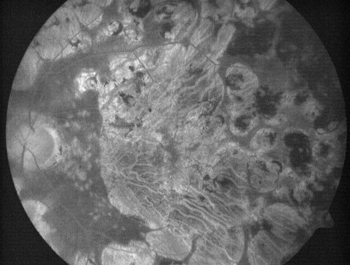 Macular and Peripheral Retinal Scarring from Diabetic Laser Done 25 years previously
72-year-old man had macular and peripheral laser done in the past(1980's)(25 years ago).  His vision, although limited, seems about stable to him.  He is diabetic for 30 years. OD is 20/160, OS  is 20/160.
