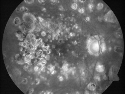Macular and Peripheral Retinal Scarring from Diabetic Laser Done 25 years previously
72-year-old man had macular and peripheral laser done in the past(1980's)(25 years ago).  His vision, although limited, seems about stable to him.  He is diabetic for 30 years. OD is 20/160, OS  is 20/160.
