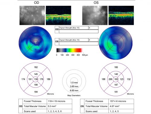 Macular and Peripheral Retinal Scarring from Diabetic Laser Done 25 years previously
72-year-old man had macular and peripheral laser done in the past(1980's)(25 years ago).  His vision, although limited, seems about stable to him.  He is diabetic for 30 years. OD is 20/160, OS  is 20/160.
