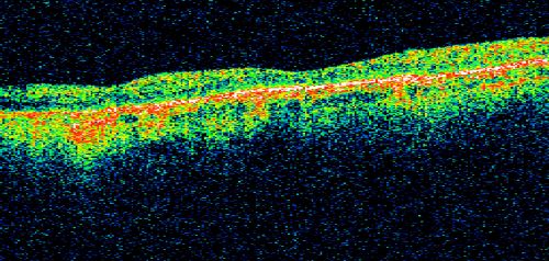 Macular Atrophy - Macular Degeneration and Previous Diabetic Macular Laser 72 Year Old Man
72-year-old man has age-related macular degeneration who had macular and peripheral laser done 30 years ago for diabetic retinopathy.  He has developed worsening macular atrophy in both eyes
