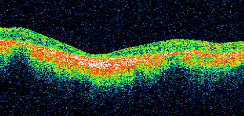 Macular and Peripheral Retinal Scarring from Diabetic Laser Done 25 years previously
72-year-old man had macular and peripheral laser done in the past(1980's)(25 years ago).  His vision, although limited, seems about stable to him.  He is diabetic for 30 years. OD is 20/160, OS  is 20/160.
