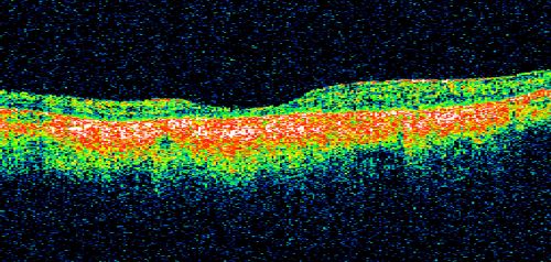Macular Atrophy - Macular Degeneration and Previous Diabetic Macular Laser 72 Year Old Man
72-year-old man has age-related macular degeneration who had macular and peripheral laser done 30 years ago for diabetic retinopathy.  He has developed worsening macular atrophy in both eyes

