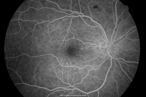 Drusen Maculopathy - Confluent Subfoveal Soft Hydrophobic Drusen - Early Fluorescein Shows no Staining of Drusen
73-year-old woman. She is diabetic for thirteen years.  She is also on Coumadin for her heart disease.  

VISUAL ACUITY:  OD 20/25, OS 20/50.  
Keywords: soft drusen;amd;confluent drusen;dry;vitelliform
