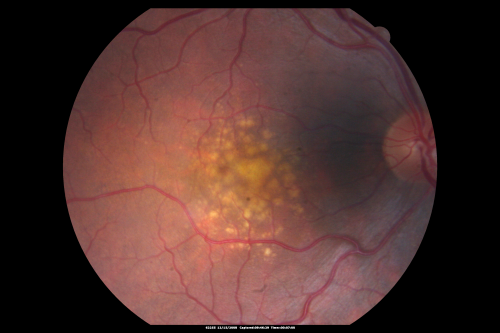 Drusen Maculopathy - Confluent Subfoveal Soft Hydrophobic Drusen - Yellow Drusen in the Center of the Macula
73-year-old woman. She is diabetic for thirteen years.  She is also on Coumadin for her heart disease.  

VISUAL ACUITY:  OD 20/25, OS 20/50.  
Palabras clave: soft drusen;amd;confluent drusen;dry;vitelliform