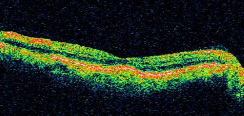 Drusen Maculopathy - Confluent Subfoveal Soft Hydrophobic Drusen - AMD OU- OCT Line Scan Shows Thickening Under Retina with Retinal Thinning
73-year-old woman. She is diabetic for thirteen years.  She is also on Coumadin for her heart disease.  

VISUAL ACUITY:  OD 20/25, OS 20/50.  
Mots-clés: soft drusen;amd;confluent drusen;dry;vitelliform