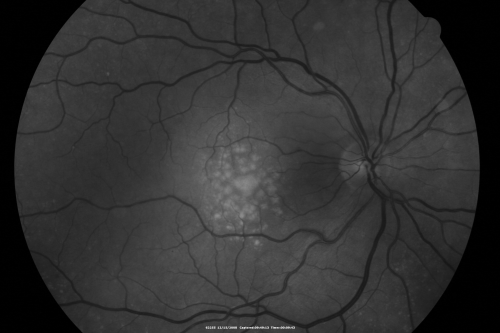 Drusen Maculopathy - Confluent Subfoveal Soft Hydrophobic Drusen - AMD OU Red Free Image shows Confluent Drusen 
73-year-old woman. She is diabetic for thirteen years.  She is also on Coumadin for her heart disease.  

VISUAL ACUITY:  OD 20/25, OS 20/50.  
Keywords: soft drusen;amd;confluent drusen;dry;vitelliform
