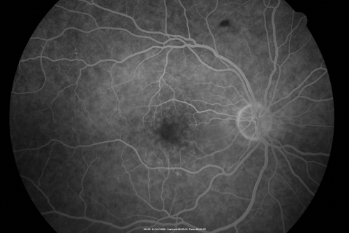 Drusen Maculopathy - Confluent Subfoveal Soft Hydrophobic Drusen - Early Fluorescein Angiogram Drusen do not yet Stain
73-year-old woman. She is diabetic for thirteen years.  She is also on Coumadin for her heart disease.  

VISUAL ACUITY:  OD 20/25, OS 20/50.  
Keywords: soft drusen;amd;confluent drusen;dry;vitelliform