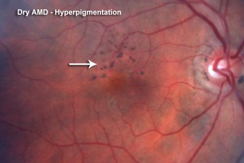 Hyperpigmentation of the Retinal Pigment Epithelium Right Eye (Treated wet AMD OS)
85-year-old man has wet age-related macular degeneration in the left eye treated for one year most recently one year ago. OD is 20/30, OS is 20/60
