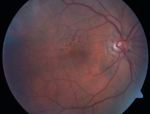 Hyperpigmentation of the Retinal Pigment Epithelium Right Eye (Treated wet AMD OS)
85-year-old man has wet age-related macular degeneration in the left eye treated for one year most recently one year ago. OD is 20/30, OS is 20/60
