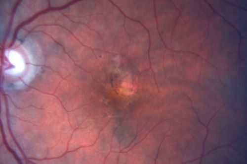 Hyperpigmentation of the Retinal Pigment Epithelium Right Eye (Treated wet AMD OS)
85-year-old man has wet age-related macular degeneration in the left eye treated for one year most recently one year ago. OD is 20/30, OS is 20/60
