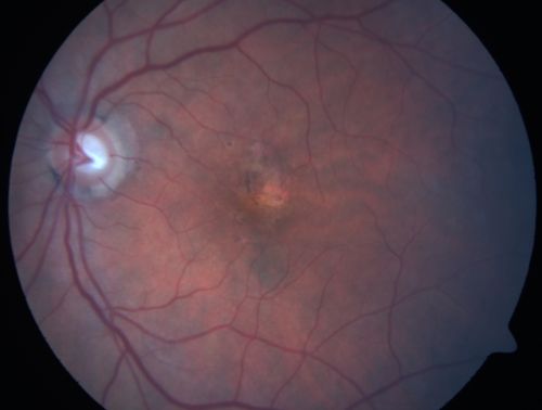 Hyperpigmentation of the Retinal Pigment Epithelium Right Eye (Treated wet AMD OS)
85-year-old man has wet age-related macular degeneration in the left eye treated for one year most recently one year ago. OD is 20/30, OS is 20/60
