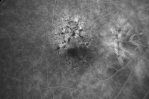 Hyperpigmentation of the Retinal Pigment Epithelium Right Eye (Treated wet AMD OS)
85-year-old man has wet age-related macular degeneration in the left eye treated for one year most recently one year ago. OD is 20/30, OS is 20/60
