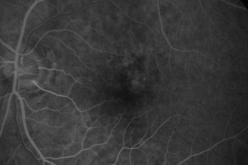Hyperpigmentation of the Retinal Pigment Epithelium Right Eye (Treated wet AMD OS)
85-year-old man has wet age-related macular degeneration in the left eye treated for one year most recently one year ago. OD is 20/30, OS is 20/60
