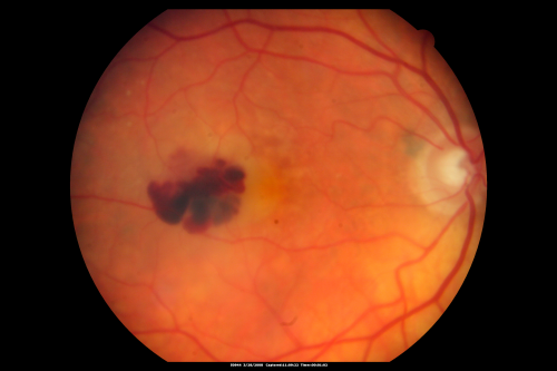 Wet AMD Small New Hemorrhage - Valsalva
79-year-old  two weeks ago he was having difficulty seeing out of the right eye. When he covered his left eye things were distorted  OD 20/50
Keywords: hemorrhage;amd;wet;valsalva