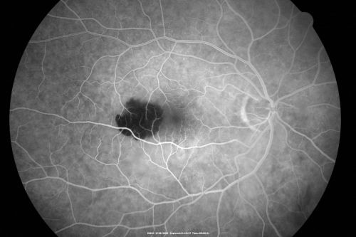 Wet AMD Small New Hemorrhage - Valsalva
79-year-old  two weeks ago he was having difficulty seeing out of the right eye. When he covered his left eye things were distorted  OD 20/50
Keywords: hemorrhage;amd;wet;valsalva