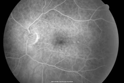 Wet AMD Small New Hemorrhage - Valsalva
79-year-old  two weeks ago he was having difficulty seeing out of the right eye. When he covered his left eye things were distorted  OD 20/50
Keywords: hemorrhage;amd;wet;valsalva