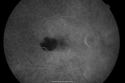 Wet AMD Small New Hemorrhage - Valsalva
79-year-old  two weeks ago he was having difficulty seeing out of the right eye. When he covered his left eye things were distorted  OD 20/50
Keywords: hemorrhage;amd;wet;valsalva