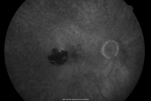 79-year-old  two weeks ago he was having difficulty seeing out of the right eye. When he covered his left eye things were distorted  OD 20/50
Keywords: hemorrhage;amd;wet;valsalva