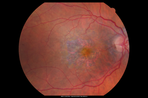Concentric Geograophic Atrophy - Age-related Macular Degeneration - Charles Bonnet Syndrome - Bulls Eye
88-year-old woman has age-related with vision gradually declining over the last year.  She sees spots in her vision, like red spots and dark spots and she even notices during the daytime, for example when she was looking at her minister, it looked like there were little flowering pots coming out of his head.  

VISUAL ACUITY:  OD 20/200,  OS 20/400.
