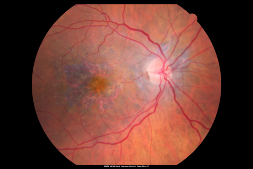 Concentric Geograophic Atrophy - Age-related Macular Degeneration - Charles Bonnet Syndrome - Bulls Eye
88-year-old woman has age-related with vision gradually declining over the last year.  She sees spots in her vision, like red spots and dark spots and she even notices during the daytime, for example when she was looking at her minister, it looked like there were little flowering pots coming out of his head.  

VISUAL ACUITY:  OD 20/200,  OS 20/400.
