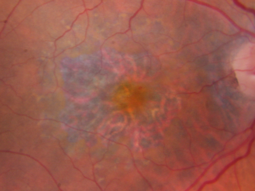 Concentric Geograophic Atrophy - Age-related Macular Degeneration - Charles Bonnet Syndrome - Bulls Eye
88-year-old woman has age-related with vision gradually declining over the last year.  She sees spots in her vision, like red spots and dark spots and she even notices during the daytime, for example when she was looking at her minister, it looked like there were little flowering pots coming out of his head.  

VISUAL ACUITY:  OD 20/200,  OS 20/400.
