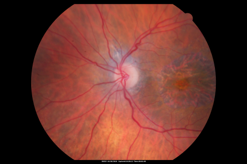 Concentric Geograophic Atrophy - Age-related Macular Degeneration - Charles Bonnet Syndrome - Bulls Eye
88-year-old woman has age-related with vision gradually declining over the last year.  She sees spots in her vision, like red spots and dark spots and she even notices during the daytime, for example when she was looking at her minister, it looked like there were little flowering pots coming out of his head.  

VISUAL ACUITY:  OD 20/200,  OS 20/400.
