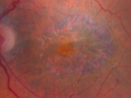 Concentric Geograophic Atrophy - Age-related Macular Degeneration - Charles Bonnet Syndrome - Bulls Eye
88-year-old woman has age-related with vision gradually declining over the last year.  She sees spots in her vision, like red spots and dark spots and she even notices during the daytime, for example when she was looking at her minister, it looked like there were little flowering pots coming out of his head.  

VISUAL ACUITY:  OD 20/200,  OS 20/400.
